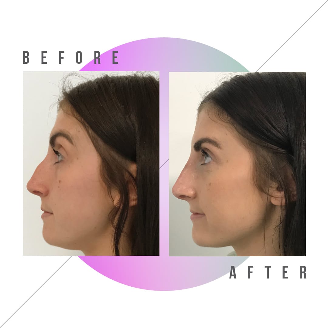 nose-1