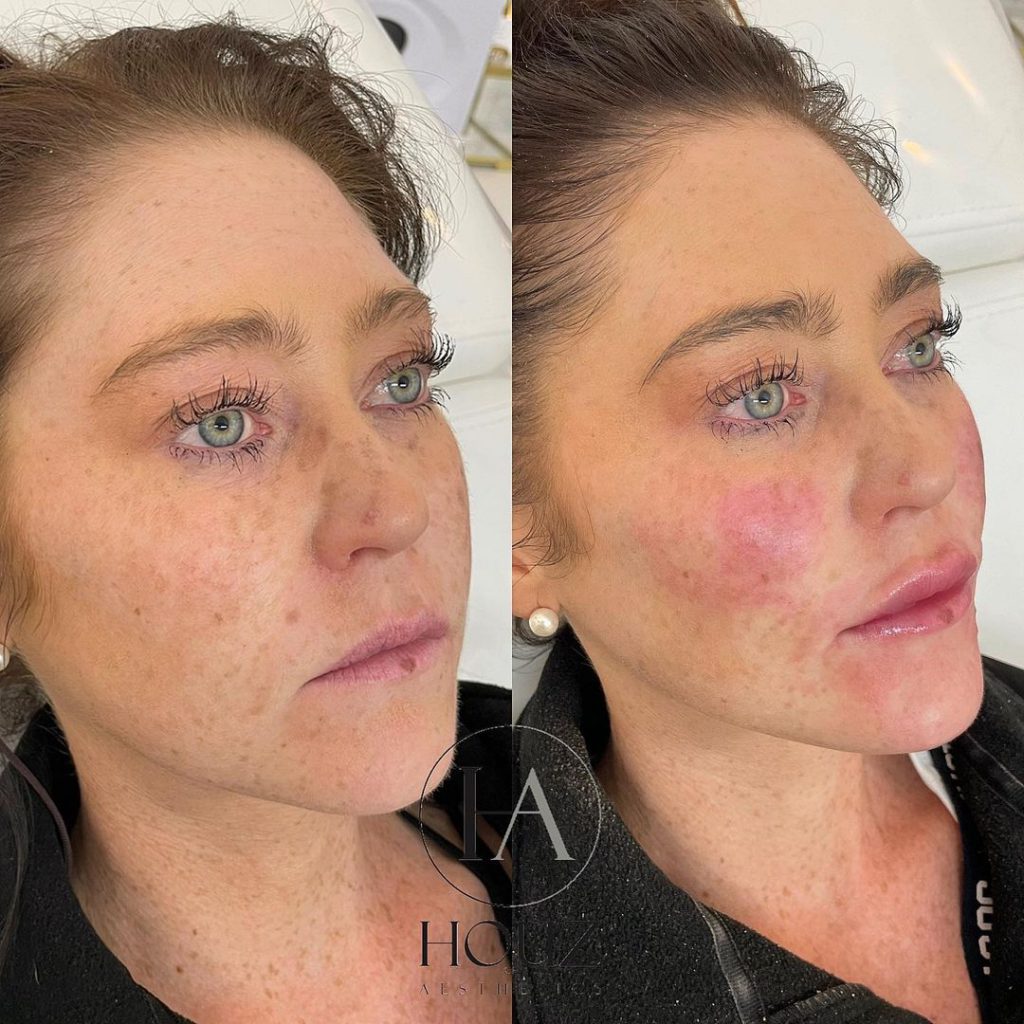 REVOLAX Before and After Transformations - REVOLAX UK