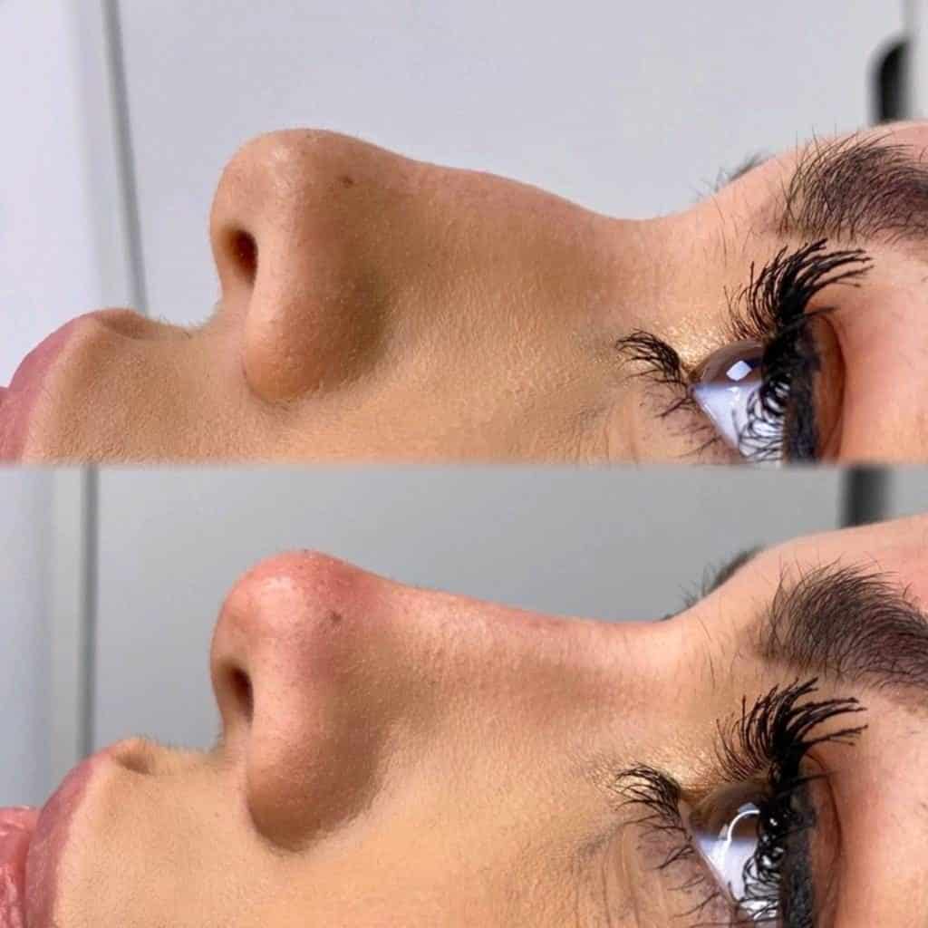 Ekin-Su Non-Surgical Rhinoplasty