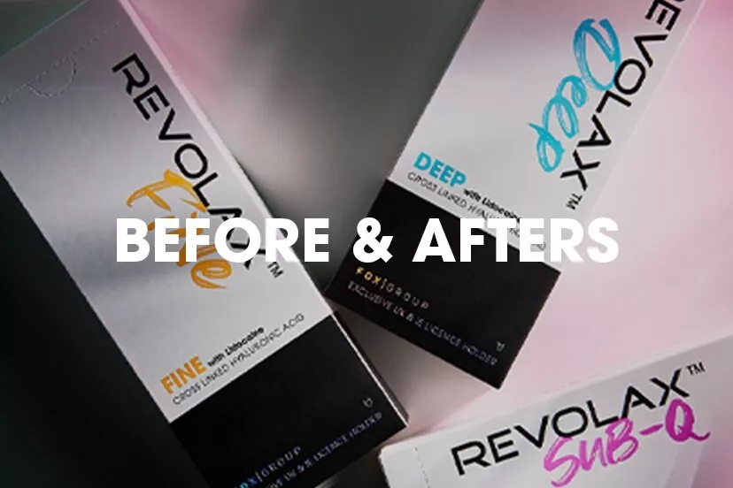 REV before and afters